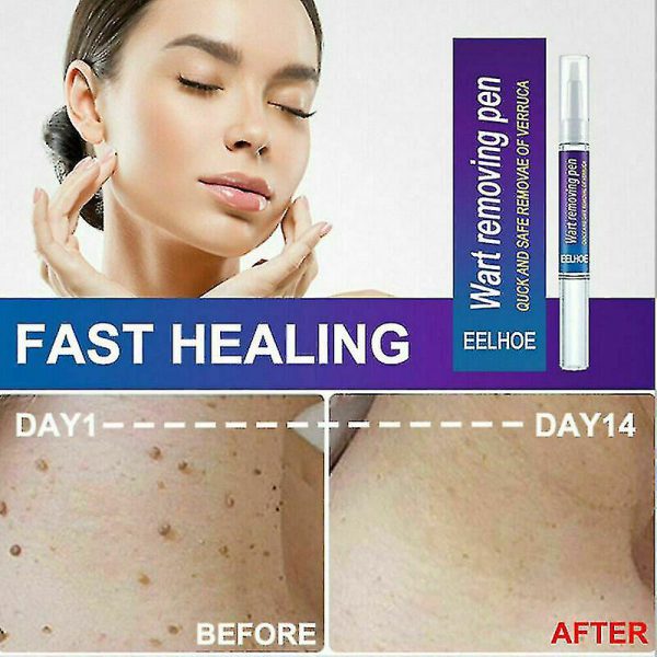 Original Wart Removal pen – Professional-Grade pen for Warts, Moles & Skin Tags | Fast-Acting, Gentle & Antibacterial Formula for Clear, Healthy Skin