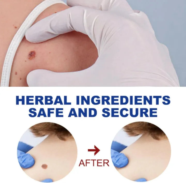 Wart Removing Pen | Instant Solution | Clinically Approved